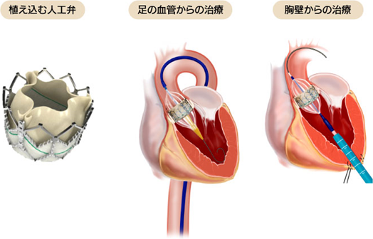Tavi Transcatheter Aortic Valve Implantation 経カテーテル大動脈弁植え込み術 手術 湘南心臓 血管外科グループ